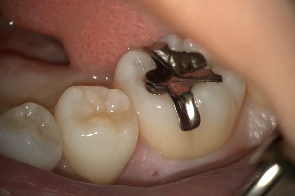 術前　銀歯