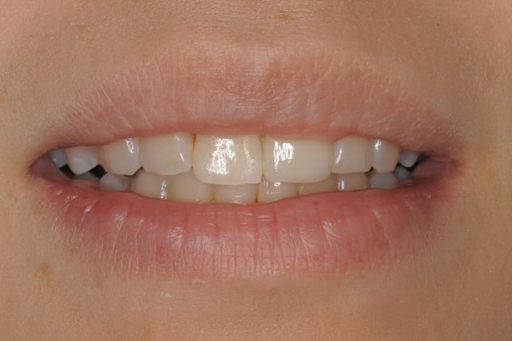 前歯をオールセラミッククラウンとラミネートベニアで修復したケース