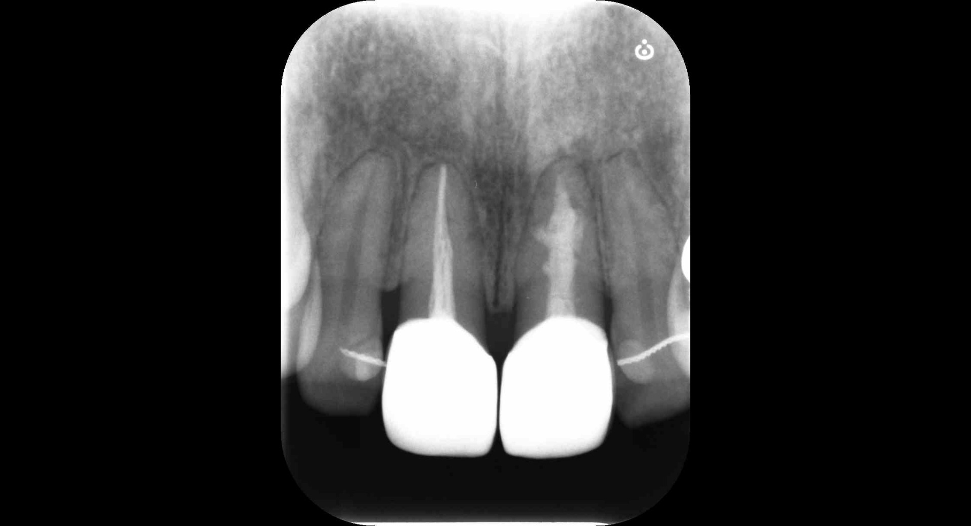 内部吸収した歯をMTAセメントにて保存したケース